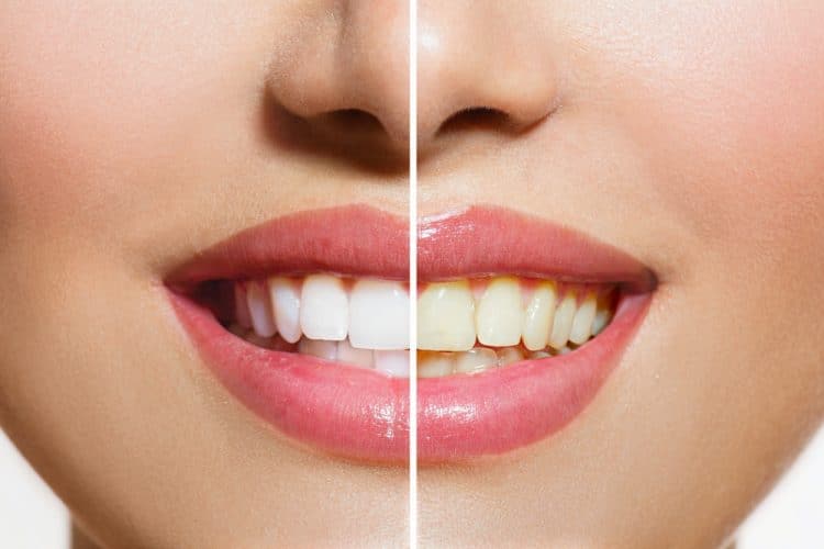 Zähne vor und nach Zahnbleaching